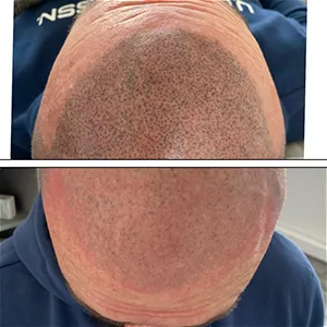hair implant